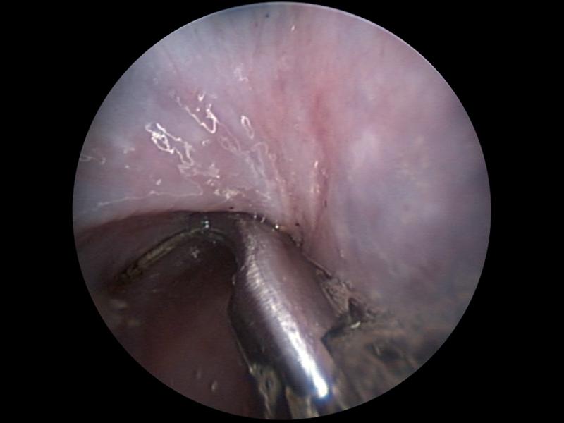Figura 4. Manejo endoscópico para la extracción de anzuelo clavado en pared esofágica mediante el empleo de portaagujas laparoscópico en paralelo al endoscopio rígido.