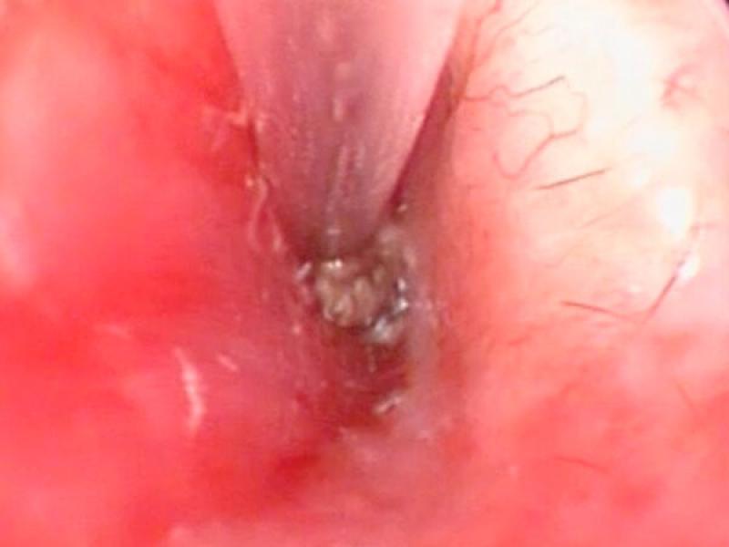 Figura 4. Momento de la miringotomía y aparición de contenido mucoso procedente de la bulla timpànica.
