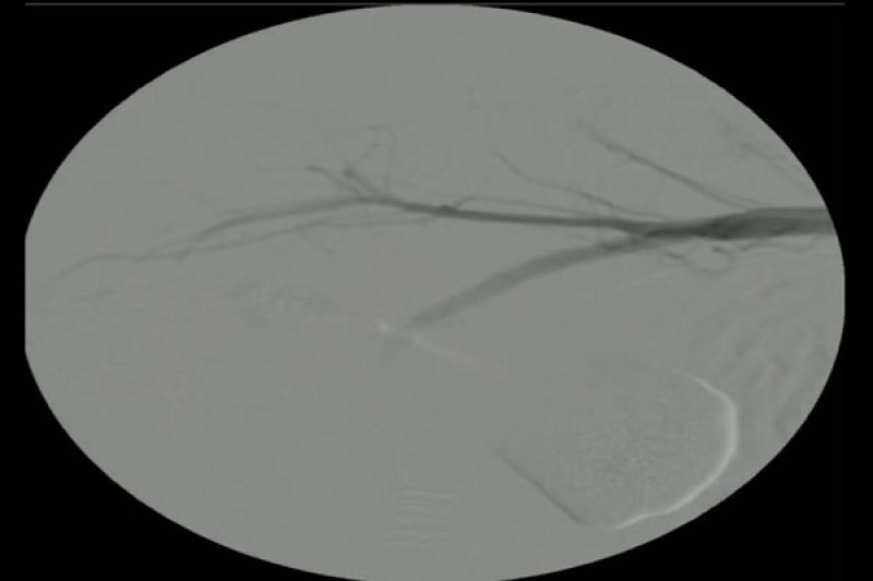 Figura 4. Nueva imagen en sustracción donde se observa ausencia de flujo arterial a nivel de arteria prostática. Dando por exitoso el procedimiento.