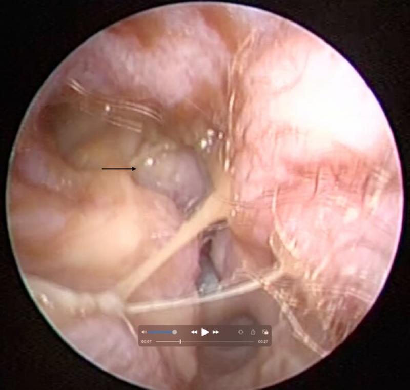 Figura 4. Presencia de secreción de aspecto purulento en el canal auditivo externo derecho. Presencia de masa de aspecto polipoide a la entrada del canal auditivo externo (flecha) y que se corresponde con granuloma inflamatorio
