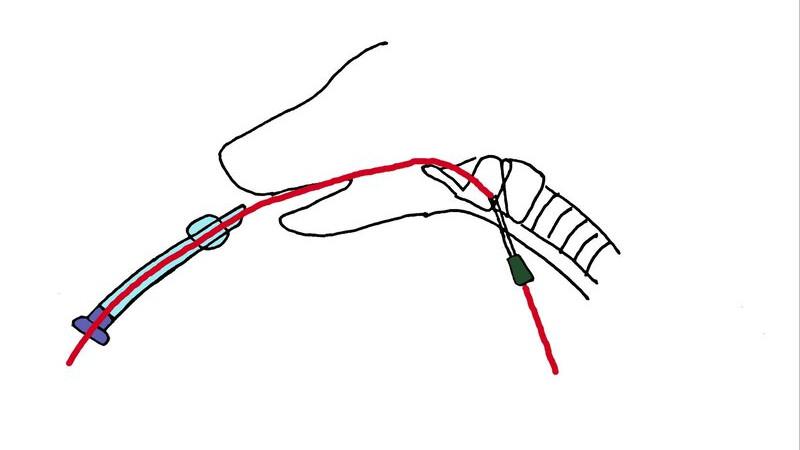 Figura 4. Representación esquemática de la técnica de intubación retrógrada. Posición del catéter intravenoso (en verde) en la laringe, y de la gía metálica (en rojo) en la laringe y orofaringe para permitir la intubación.