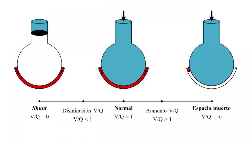 Figura 4. Representación esquemática de las alteraciones en la relación entre la ventilación y la perfusión (V/Q). En condiciones normales, existe un equilibrio entre la ventilación y la perfusión (V/Q ? 1). La disminución de la ventilación con respecto a la perfusión (V/Q  1) puede dar lugar a espacio muerto (V/Q = ?). Adaptado de West (2012).