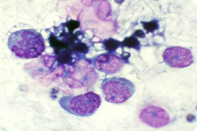 Figura 40. Hialitis por Toxoplasmosis.
