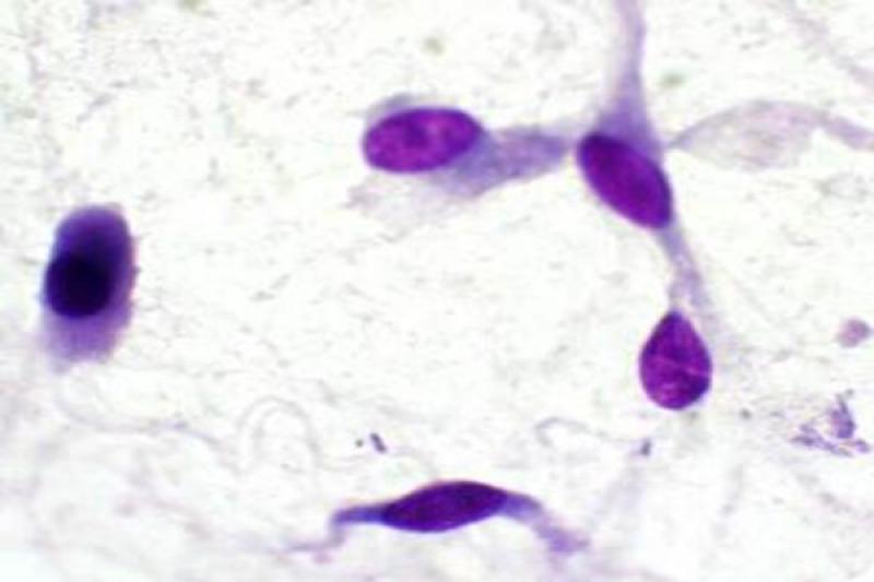 Figura 43. Adenocarcinoma retrobulbar. Macrocariosis y vacuolización perinuclear.