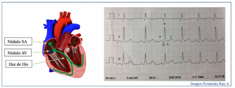 Figura 4.Estimulación eléctrica cardíaca y formación de ondas en el ECG.
