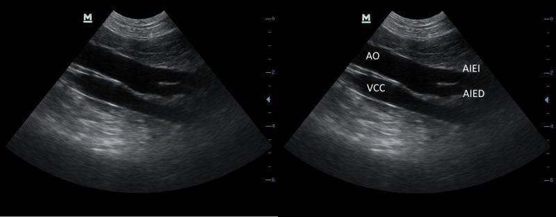 Figura 5: Abordaje 1. Vena cava caudal (VCC). Arteria aorta abdominal (AO) con la emergencia de las arterias iliacas externas izquierda (AIEI) y derecha (AIED).