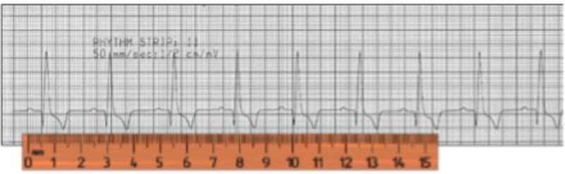 Figura 5. Cálculo de la frecuencia cardíaca. A una velocidad de 50mm/seg, en 15 cm de papel hay 7 latidos (esto equivale a 3seg), en un minuto (x20)= 7 x 20= 140lpm.