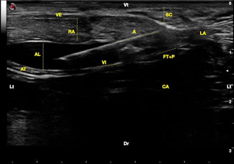 Figura 5. Deposito del anestésico local (AL) entre el músculo recto abdominal (RA) y su vaina interna (VI). Aguja (A), línea alba (LA), tejido subcutáneo (SC), vaina externa del recto abdominal (VE), músculo abdominal transverso (AT), fascia transversalis (FM), peritoneo (P), cavidad abdominal (CA), lateral (Lt), ventral (Vt) y dorsal (Dr).