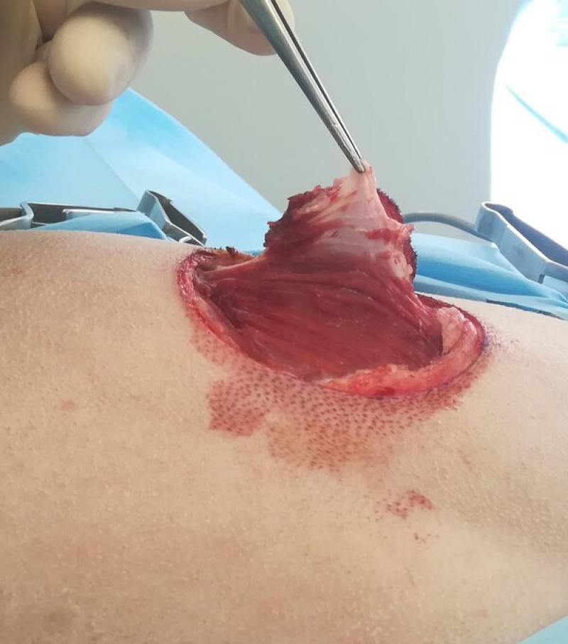 Figura 5: Detalle de la resección en profundidad incluyendo un plano fascial en la cirugía. Se retira la fascia muscular en bloque junto al resto de la escisión.