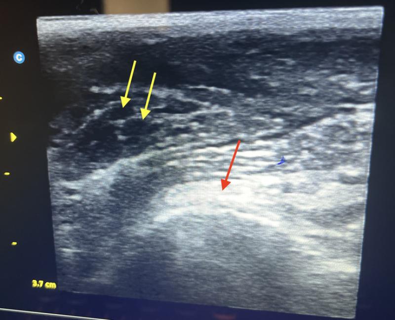 Figura 5. ecografía musculoesquelética del tríceps braquial derecho. Las flechas amarillas indican la presencia de focos hipoecoicos en la porción central del tendón, a nivel de la unión músculo- tendinosa. La flecha roja indica la zona de localización del olécranon.