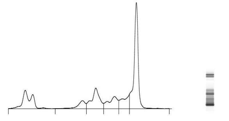 Figura 5. Electroforesis de proteínas séricas. Gammapatía monoclonal en un perro con mieloma múltiple. El pico de la derecha representa las gammaglobulinas.