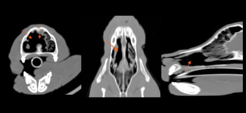 Figura 5. Estudio TC donde se demuestra marcada lisis de las conchas nasales asociada a la ANC.