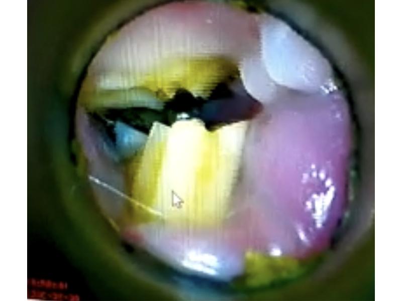Figura 5. Exploración con video-otoscopio de primeras piezas malares sin alteraciones patológicas. Arcada derecha.