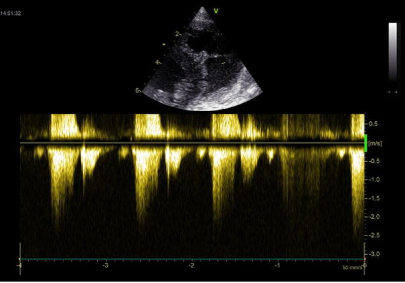 Figura 5. Imagen de Doppler continuo para valorar la velocidad a nivel del orificio ventricular.