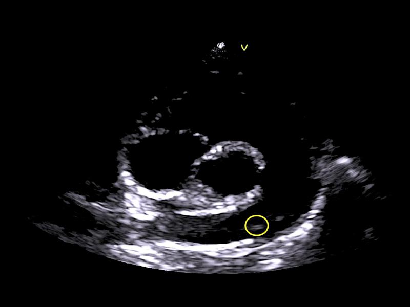 Figura 5. Imagen ecocardiográfica de un gato parasitado. Vista paraesternal derecha. Corte transversal o de eje corto a nivel de la bifurcación de las arterias pulmonares, donde se observa imagen compatible con vermes adultos de Dirofilaria immitis (flecha amarilla).
