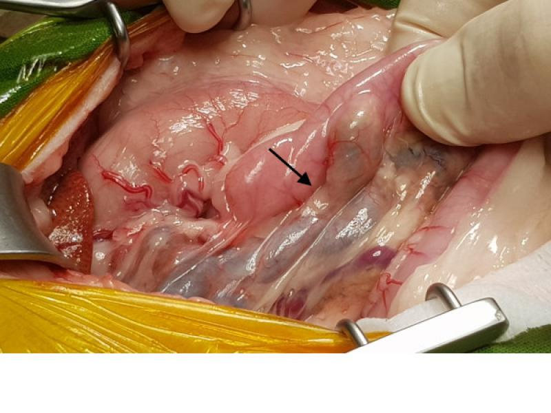 Figura 5. Imagen intraoperatoria donde se ve tortuosidad del tracto biliar antes de la entrada al duodeno.