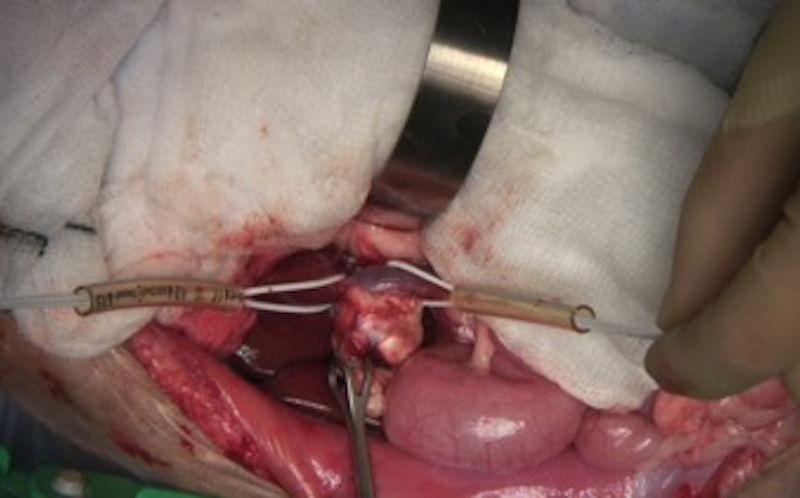 Figura 5. Imagen intraquirúrgica de una masa adrenal derecha que invade la vena cava caudal en un gato con hiperaldosteronismo primario.