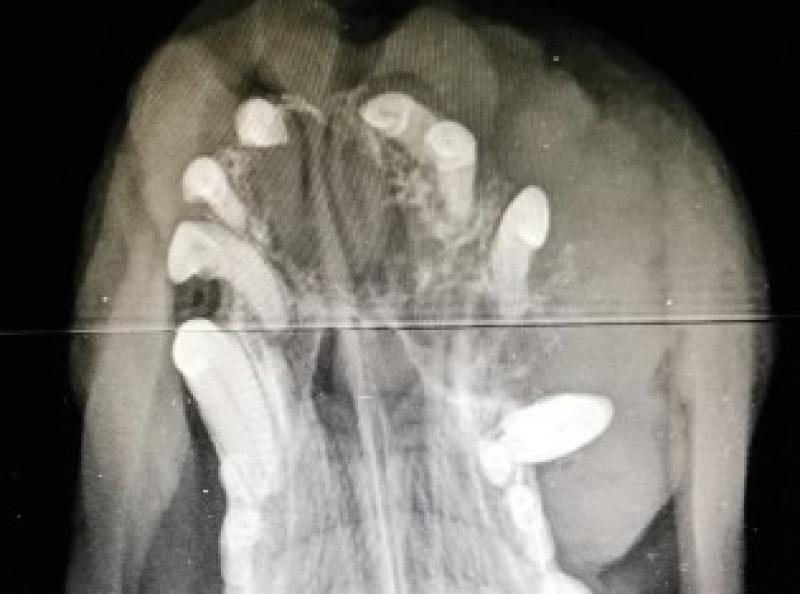 Figura 5. Imagen radiográfica de la región maxilar, se aprecia osteolisis y desplazamiento de piezas dentales.