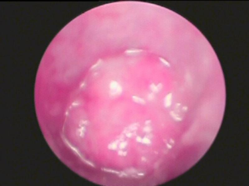 Figura 5. Imagen vídeootoscópica de pólipo inflamatorio.