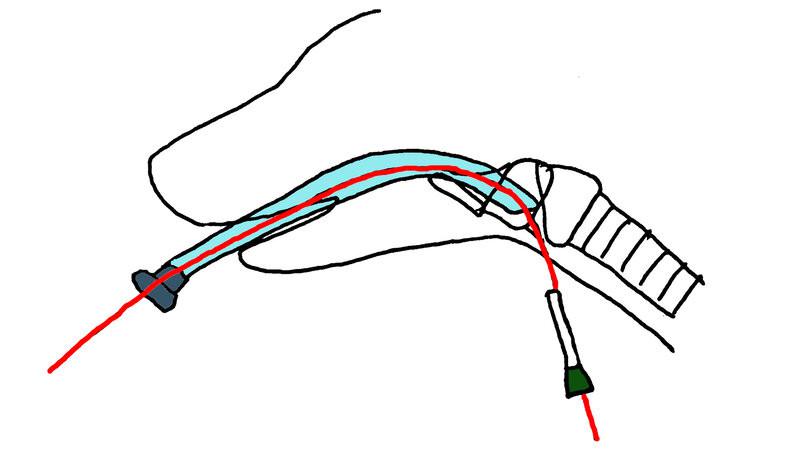 Figura 5. Representación esquemática de la técnica de intubación retrógrada. Introducción del tubo endotraqueal (en azul)hasta el punto de inserción de la guía, tras lo cual esta será retirada y el tubo avanzado hacia la tráquea.