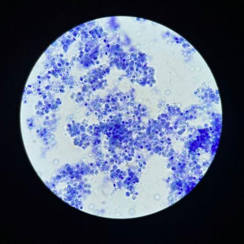 Figura 5: Sedimento teñido con azul de metileno. Leucocituria severa y bacteriuria marcada.