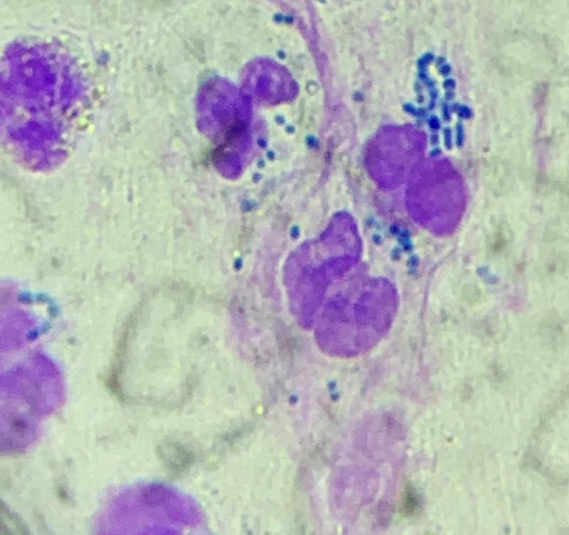 Figura 5. Sedimento urinario mostrando neutrófilos con formas cocoidales fagocitadas durante el episodio de pielonefritis.