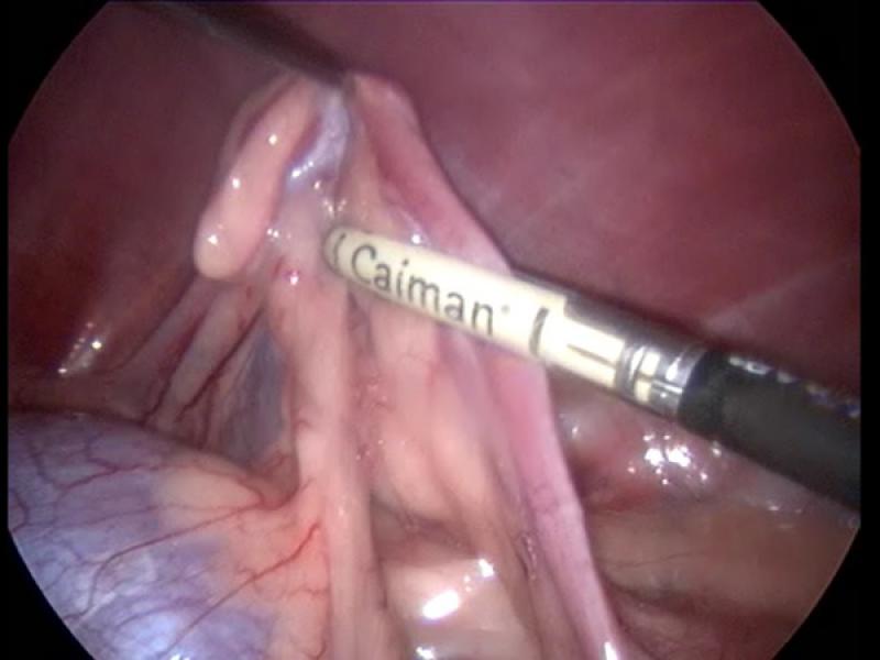 Figura 5. Sellado vascular en Cirugía laparoscópica. Cedido por Diego Bobis Villagrá.