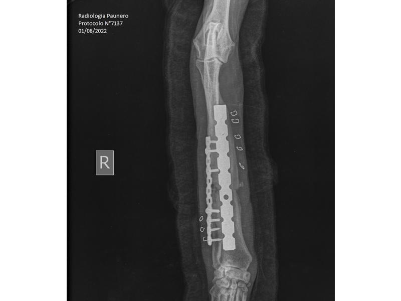 FIGURA 5.Radiografías posoperatorias, donde se evidencia la osteomielitis en curso (reacción periodística, inflamación de tejidos blandos zonas de lísis).