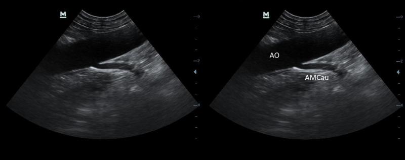 Figura 6: Arteria mesentérica caudal (AMcau) emergiendo de la cara ventral de la arteria aorta abdominal (AO).