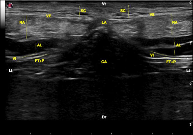 Figura 6. Corte transversal sobre la línea alba (LA) tras la administración bilateral del anestésico local. Se observa de ventral a dorsal el tejido subcutáneo (SC), la vaina externa del recto abdominal (VE), el vientre muscular del recto abdominal (RA), el anestésico local (AL), la vaina interna del recto abdominal (VI), la conjunción de la fascia transversalis (FM) y el peritoneo (P), y el interior de la cavidad abdominal (CA). Lateral (Lt), ventral (Vt) y dorsal (Dr).