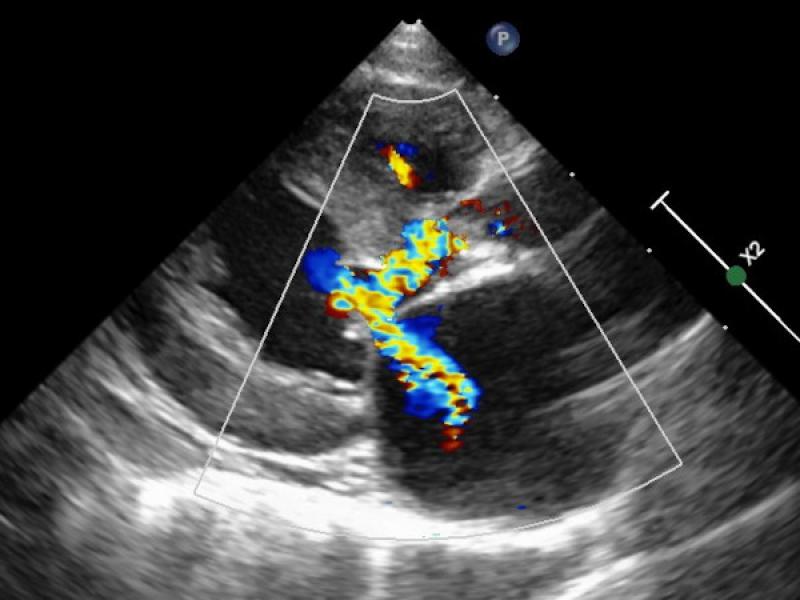 Figura 6: Ecocardiografía transtorácica donde se puede apreciar hipertrofia de las paredes del ventrículo izquierdo e insuficiencia de la válvula mitral asociada a un movimiento sistólico anterior de la válvula mitral.