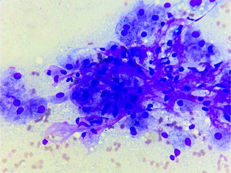 Figura 6. Fibrosis hepática. Véanse las células mesenquimales con núcleo alargado que se dispone en finas bandas de matriz rosa y fibrilar.