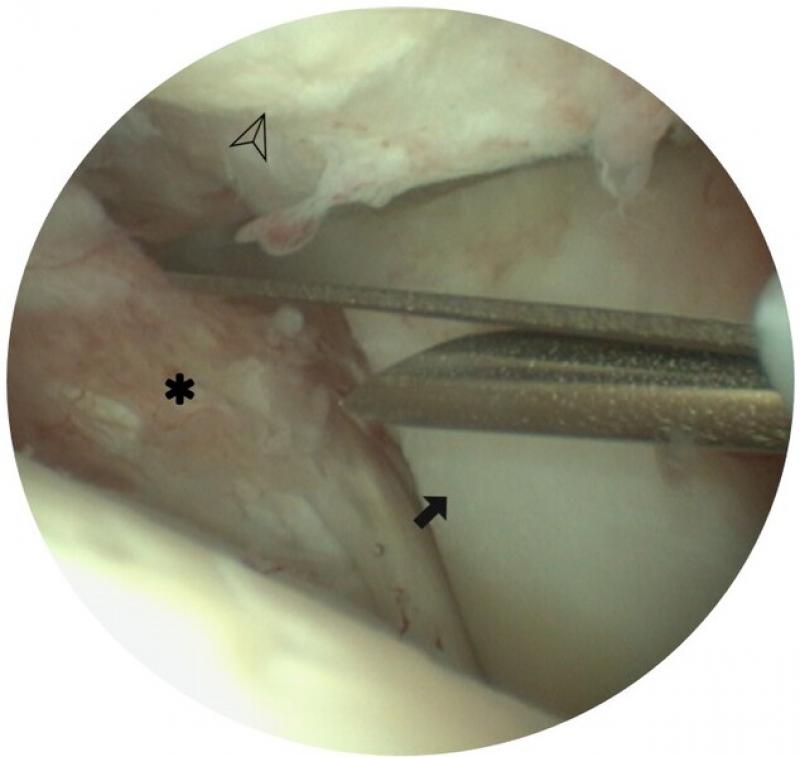 Figura 6. IImagen artroscópica del origen del tendón del bíceps braquial antes de la sección. Se observa el tubérculo glenoideo (cabeza de flecha), el tendón del bíceps braquial (flecha) y la inflamación sinovial circundante (asterisco).