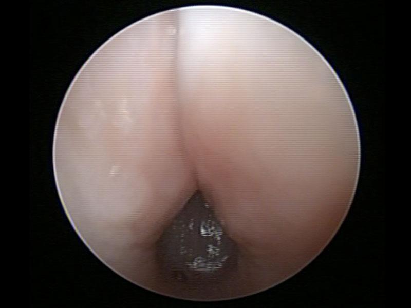 FIGURA 6. Imagen endoscópica de colapso laríngeo grado III en paciente braquicéfalo extremo.