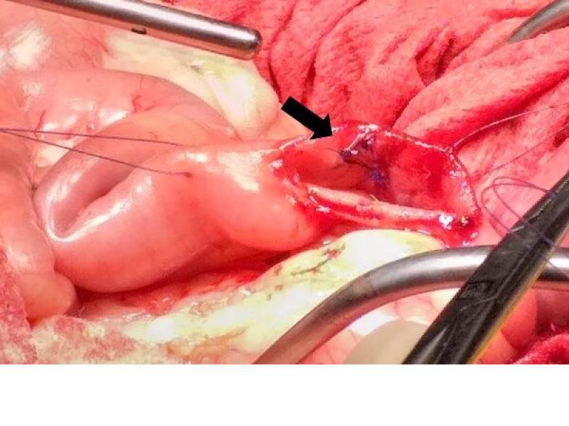 Figura 6. Imagen intraoperatoria tras realizar duodenotomía, el conducto colédoco se ha cateterizado con un stent y se ve una parte de este saliendo en el lumen duodenal.