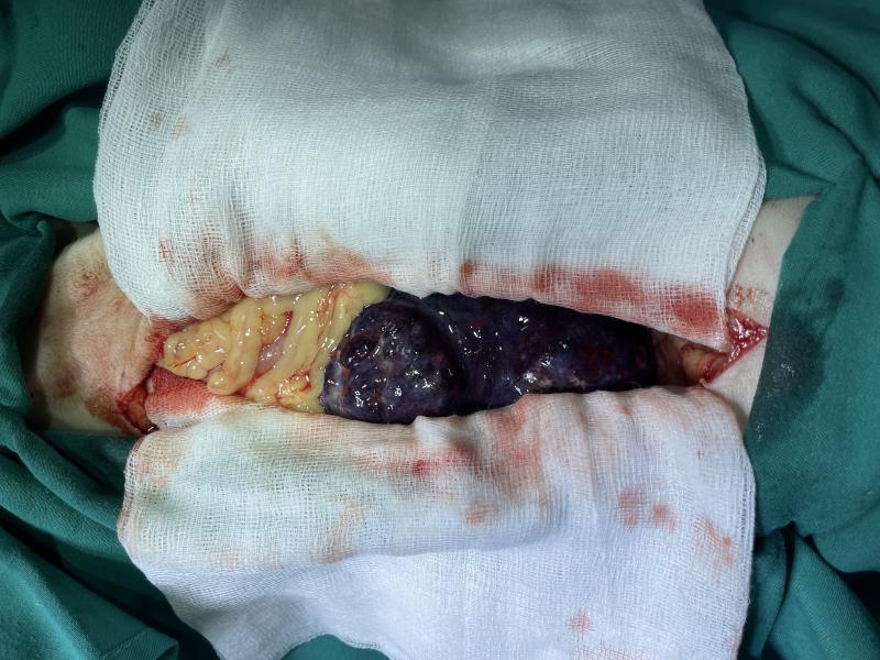 FIGURA 6. Imagen intraquirúrgica de la celiotomía exploratoria después de realizar succión del líquido abdominal y amputación del ligamento falciforme.