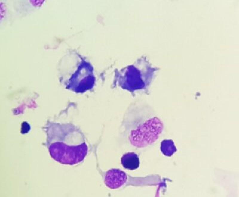 Figura 6. Imagen microscópica (x100). En la imagen de la izquierda se observan macrófagos activados y linfocitos junto a una célula epitelial de un lavado broncolveolar de caballo.