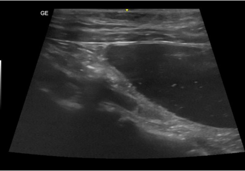 Figura 6: Lesión hiperecogénica compatible con un tromboembolismo en el interior de la aorta abdominal (asterisco blanco).