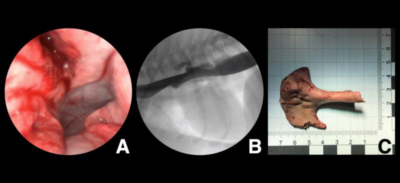 Figura 6. Perforación esofágica secundaria a cuerpo extraño esofágico candidata a manejo conservador. Aspecto endoscópico (A). Esofagograma de contraste (B). Aspecto macroscópico del cuerpo extraño (C).