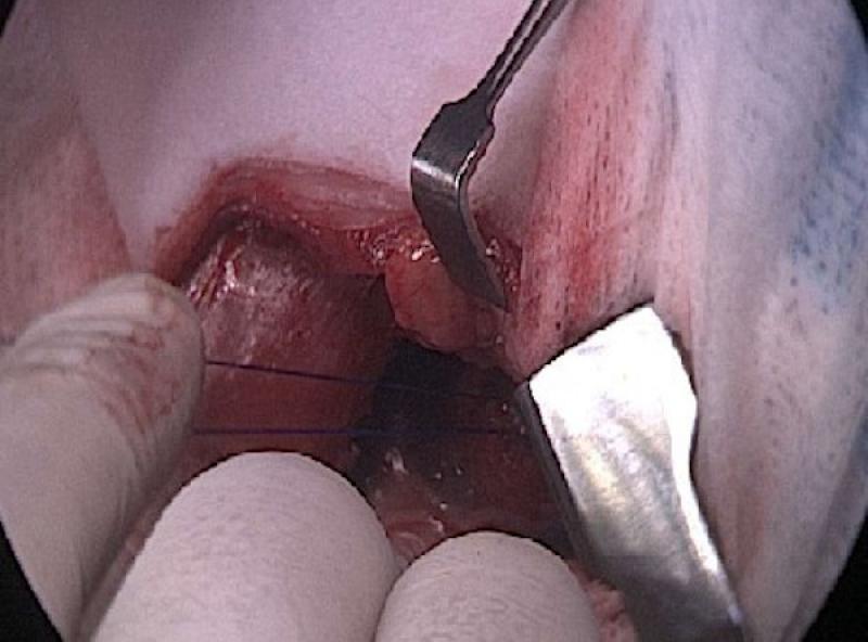 Figura 6. Retirado el tubo traqueal se anudan ambos extremos de las suturas entre si con nudos simples.