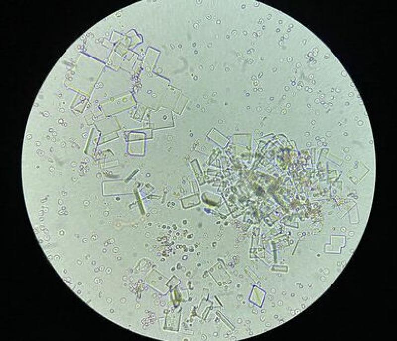 Figura 6. Sedimento con hematuria marcada y cristales de fosfato amónico magnésico abundantes.