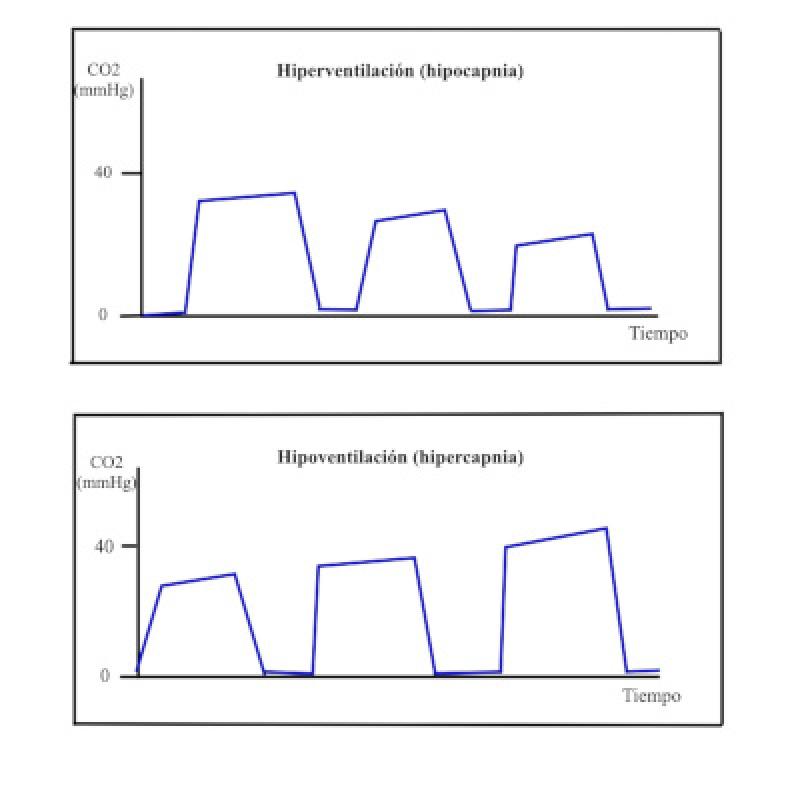 Figura 6. Trazado capnográfico de hiperventilación ? hipocapnia (disminución del CO2), e hipoventilación ? hipercapnia (incremento del CO2).