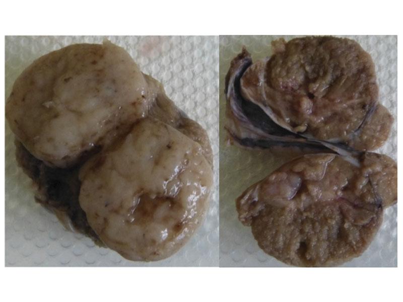 Figura 6.Sección de testículos neoplásicos. Izquierda: la neoplasia afecta todo el testículo; derecha se observa parénquima testicular junto a la presencia de un crecimiento neoplásico. La biopsia es imprescindible para caracterizar la neoplasia