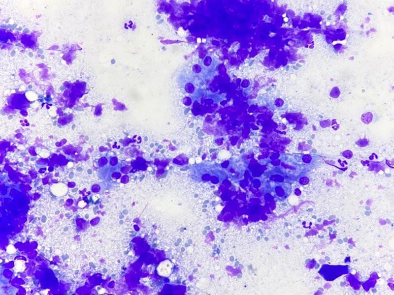 Figura 7. AMmiloidosis con inflamación neutrofilica. El amiloide se identifica como un material extracelular, rosa, amorfo a fibrilar entre los hepatocitos.