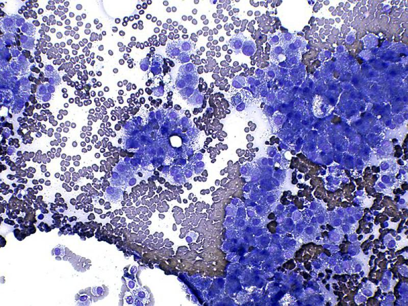 Figura 7 C. Tumores adrenocorticales. (C, D) neoplasia maligna (adenocarcinoma), con moderadas características de malignidad. Tinción de tipo Romanowsky, objetivos de 20x (A, C) y 40x (B, D).
