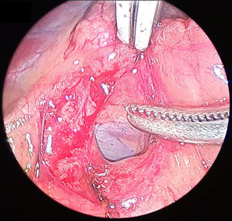 Figura 7. Disección medial de la glándula adrenal izquierda, al fondo y de color morado se visualizan la vena cava y la vena renal izquierda.