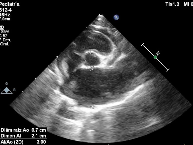 Figura 7: Ecocardiografía transtorácica en corte paraesternal izquierdo eje corto optimizado a nivel de la base cardíaca. Detalle de la marcad dilatación de la aurícula izquierda.