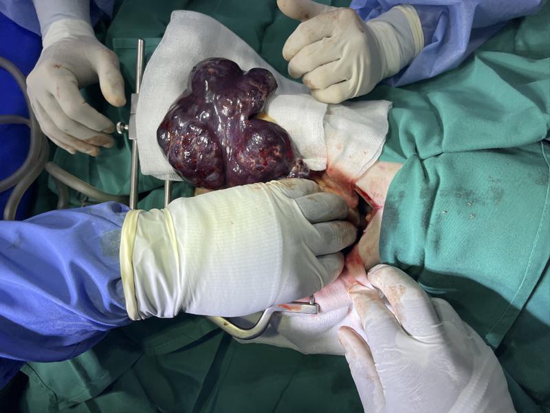 FIGURA 7. Imagen intraquirúrgica de la masa esplénica.