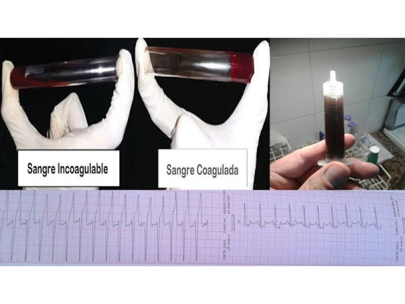 Figura 7: Sangre que no coagula, en la jeringa presencia de mioglobina y el electrocardiograma muestra taquicardia ventricular que retoma a ritmo sinusal al administrar lidocaína.