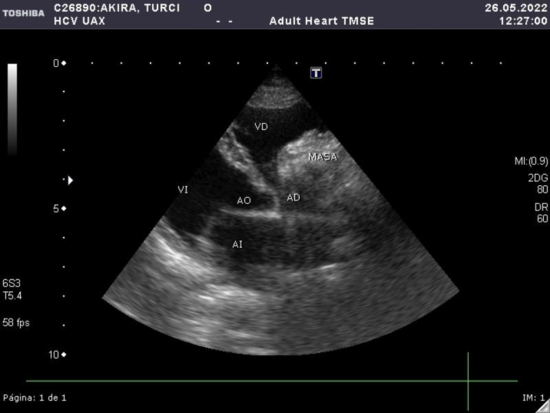 FIGURA 7. Se observa un HSA cardiaco en aurícula derecha. Cortesía de Ana González Hernández Servicio de diagnóstico por imagen del HCV UAX